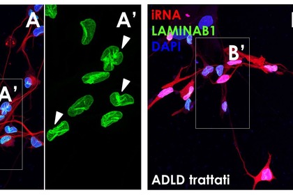 Leucodistrofia dell'adulto: nuovo approccio dall'interferenza a Rna