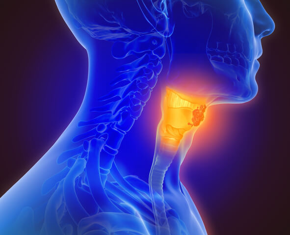 Come il cancro della tiroide si trasforma in malattia cronica
