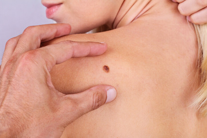 «Oltre la pelle»: la lotta al melanoma scende in piazza