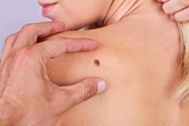 L'immunoterapia ha trasformato il melanoma in una malattia cronica