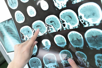 Glioblastoma: via libera a un nuovo farmaco 