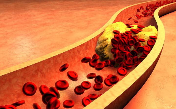 Colesterolo Ldl: dopo un ictus cerebrale meglio «fermarsi» a 70