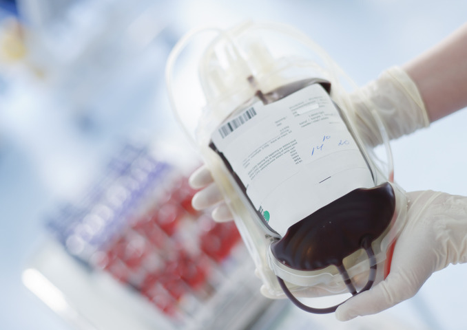 Beta talassemia: con la terapia genica pazienti liberi dalle trasfusioni 