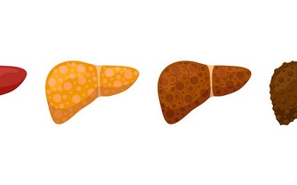 Come faccio a sapere se ho la steatoepatite non alcolica (Nash)?