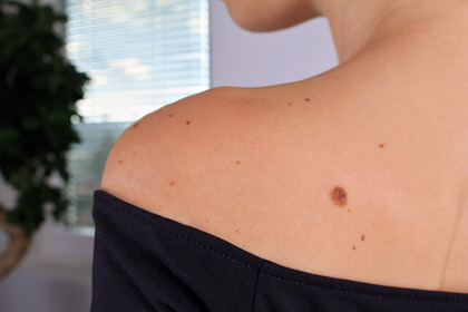 Melanoma: ora l'obiettivo è aumentare l'efficacia dell'immunoterapia