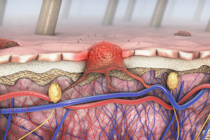 In quali organi tende a diffondersi il melanoma? 