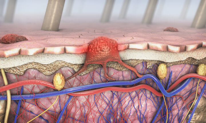 In quali organi tende a diffondersi il melanoma? 