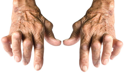 Artrita reumatoida (reumatismul) si osteoartrita: Cauze si tratamente | volksparts.ro