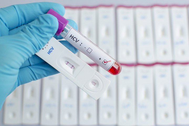Epatite C: eradicarla con screening mirati e terapie antivirali