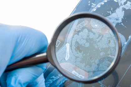 Tumore del colon con instabilità dei microsatelliti: l'immunoterapia funziona
