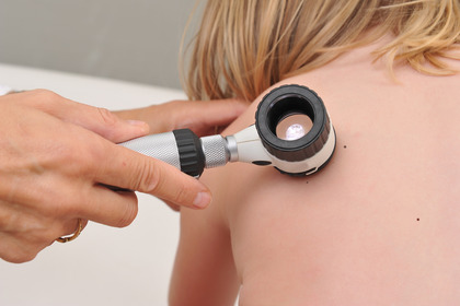 Melanoma BRAF mutato: doppia terapia target per evitare le recidive