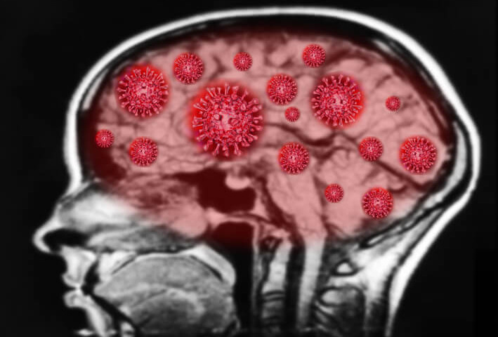 «Neurocovid»: quando il coronavirus attacca il cervello