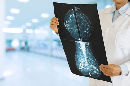 Tumore al seno HR+ HER2-: cure sempre più mirate
