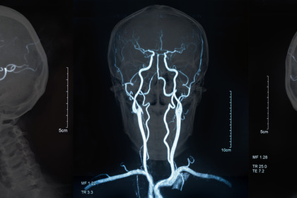 Ictus: l'importanza della prevenzione e delle Stroke Unit