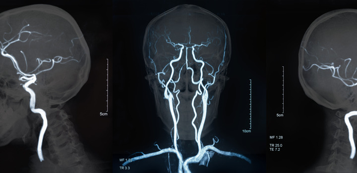 Ictus: l'importanza della prevenzione e delle Stroke Unit