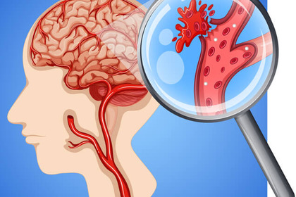 Ictus cerebrale: la gravità si può dedurre da una goccia di sangue 