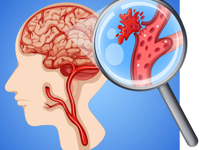 Ictus cerebrale: la gravità si può dedurre da una goccia di sangue 