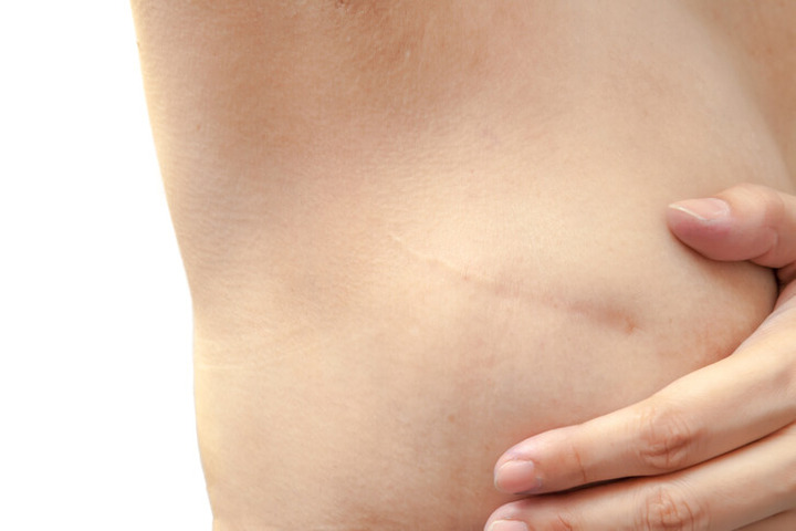 Tumore al seno: quando si ricorre allo svuotamento del cavo ascellare?