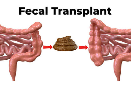 Un trapianto di flora intestinale contro un'infezione batterica incurabile