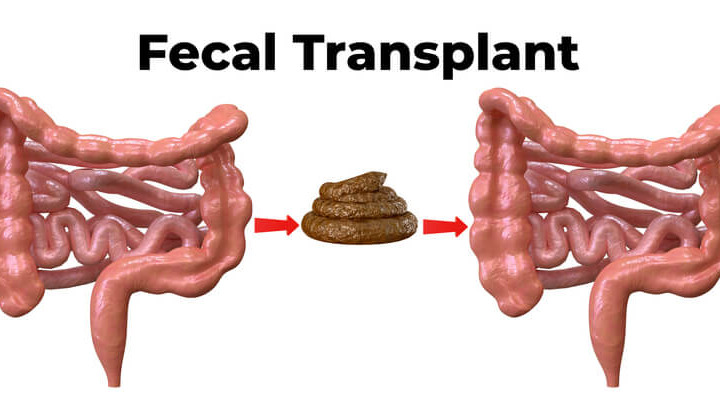 Un trapianto di flora intestinale contro un'infezione batterica incurabile