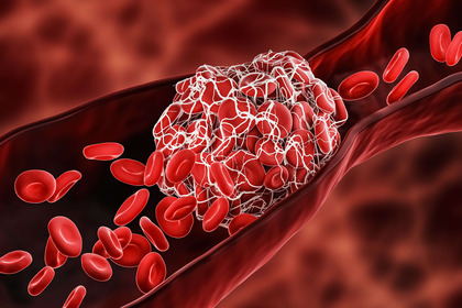 Vaccini, Covid-19 e trombosi: domande e risposte