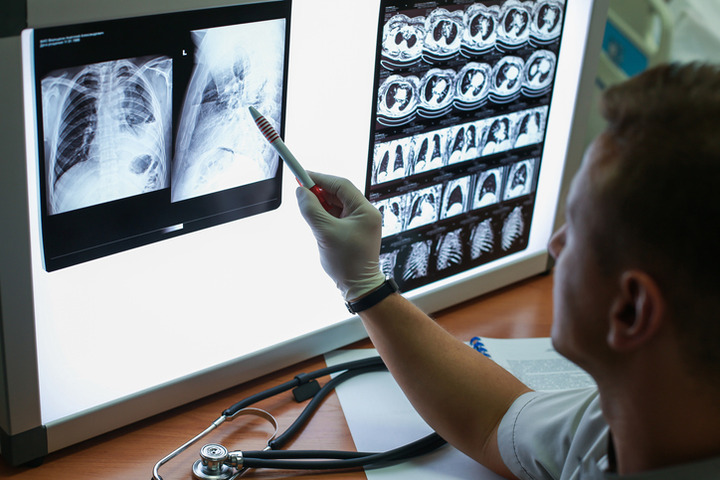 Tumore del polmone: che cos'è la brachiterapia?