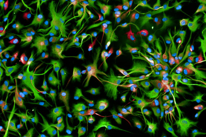 Gliomi diffusi della linea mediana: curarli con Car-T e terapie target