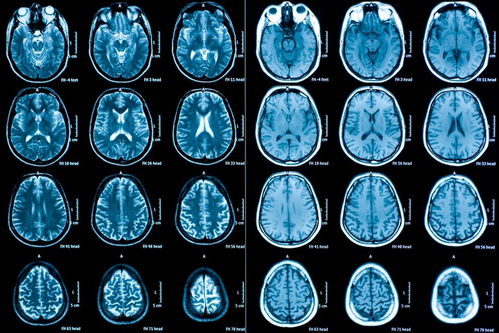 Il disturbo bipolare lascia impronte nel cervello