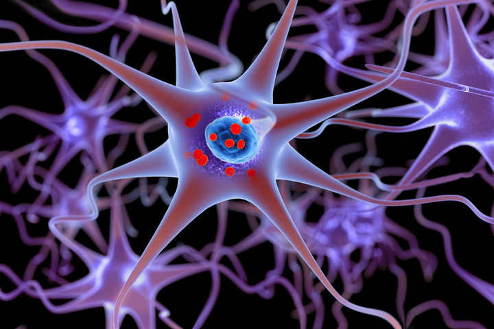 Fra gli infartuati il rischio di Parkinson non aumenta, anzi