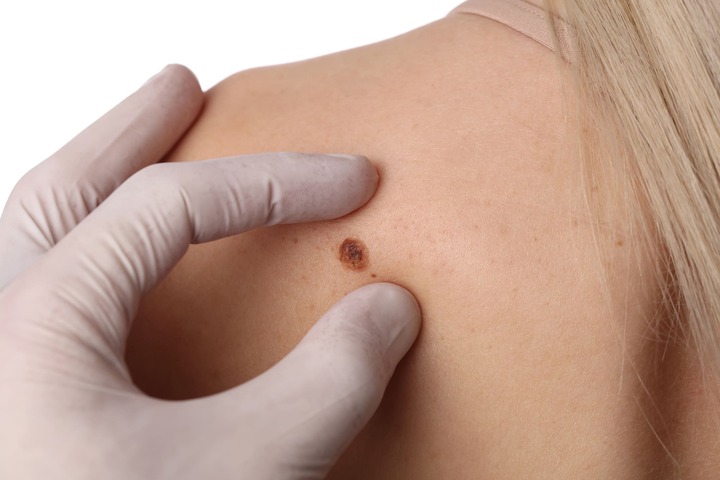 Melanoma: la vittoria dell'immunoterapia