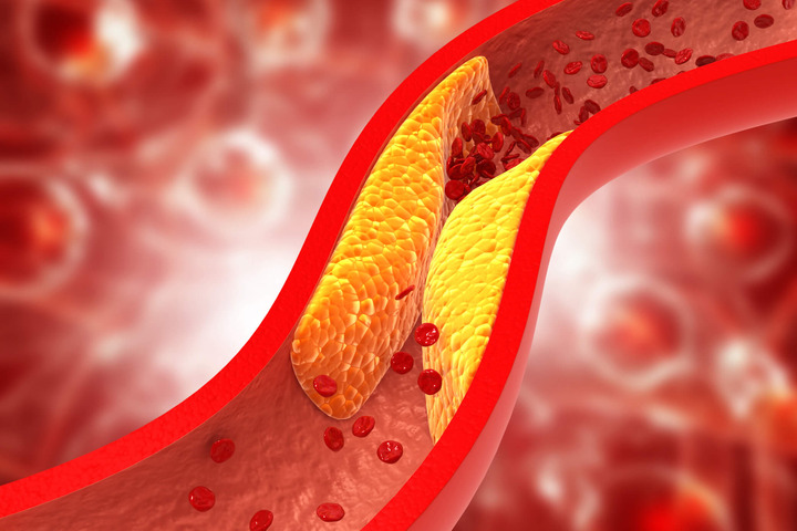 Aterosclerosi: le placche arteriose “comunicano” con il cervello