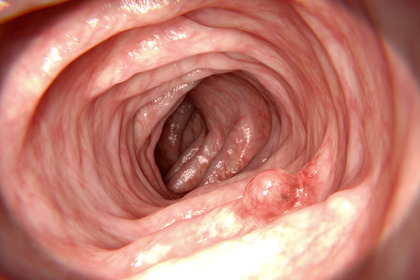 Immunoterapia neoadiuvante: una svolta nel tumore del colon dMMR