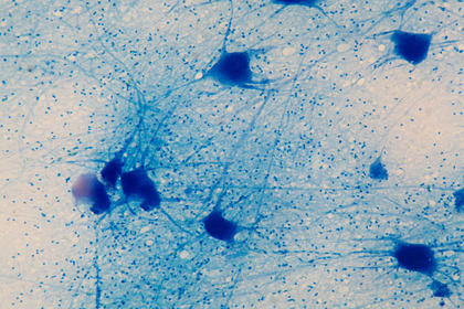 SLA SOD1: passi avanti nella ricerca ma la cura è ancora lontana