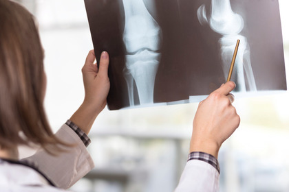 Il litio può essere utile contro l'osteoporosi