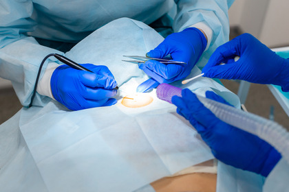 Un gel Car-T dopo l'operazione per ridurre il rischio recidiva