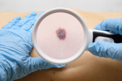 Melanoma: l'immunoterapia neoadiuvante riduce le recidive