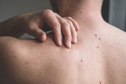 Melanoma: uno zucchero per migliorare gli effetti delle terapie