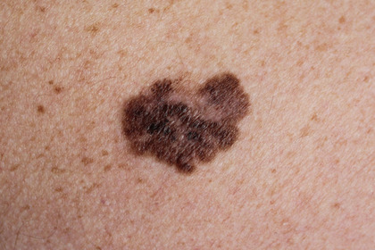 Melanoma: immunoterapia e vaccino a mRNA per evitare le recidive