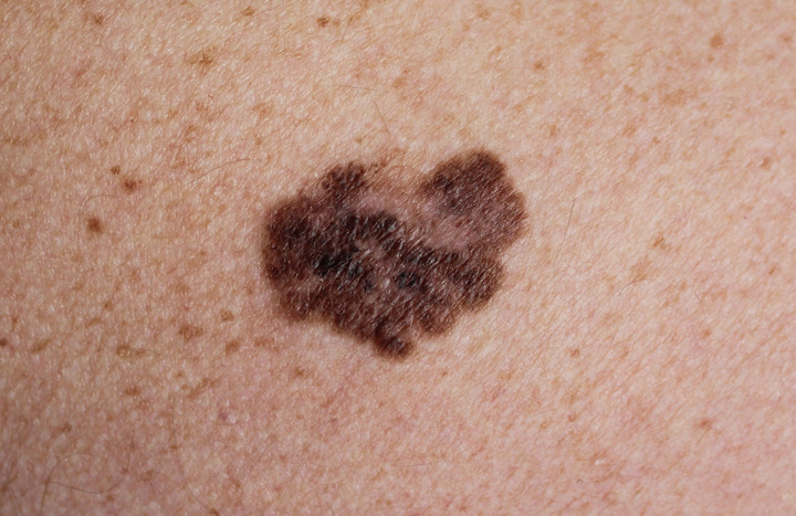 Melanoma: immunoterapia e vaccino a mRNA per evitare le recidive