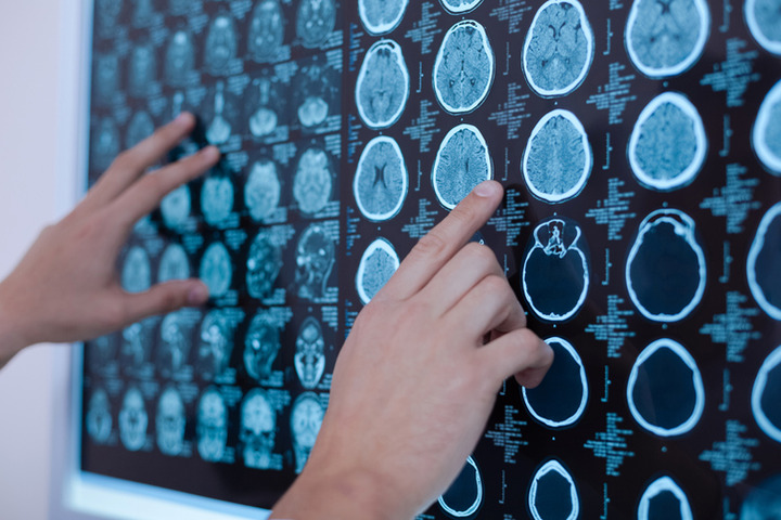 Glioma nei giovani: una terapia target per contenere la malattia