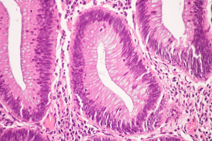 Tumore al seno triplo negativo: quando usare l'immunoterapia?