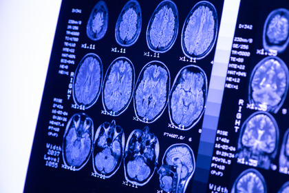 Glioblastoma: così diventa resistente ai trattamenti. Ma forse si può bloccare