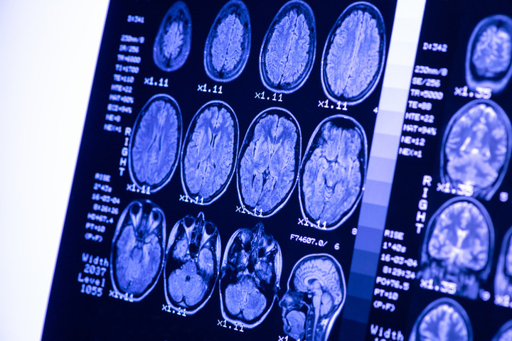 Glioblastoma: così diventa resistente ai trattamenti. Ma forse si può bloccare