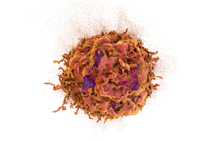 Melanoma: approvata la prima terapia cellulare con i TILs