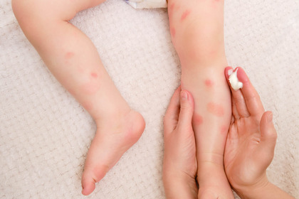 Qual è il legame tra allergie stagionali e dermatite?