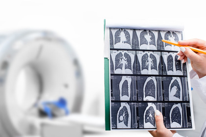 Tumore del polmone EGFR: i successi della terapia target