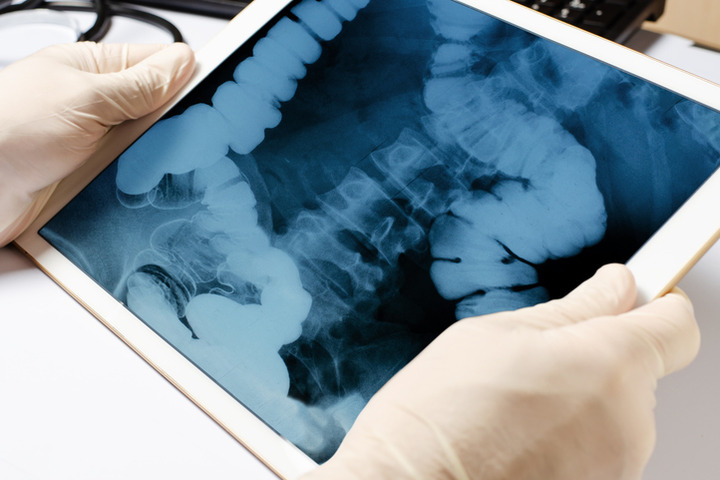 Tumore del colon-retto: davvero si guarisce con l'immunoterapia?
