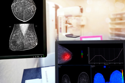 Tumore al seno triplo negativo: nuova immunoterapia all'orizzonte?