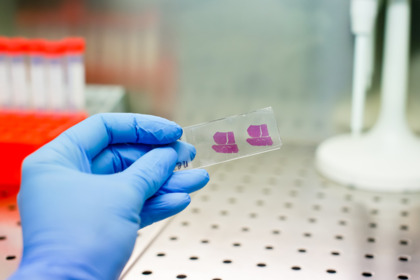 Doppia biopsia: così la cura dei tumori diventa su misura