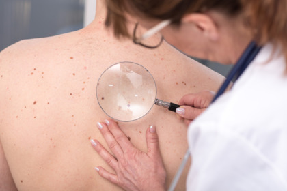 Melanoma: con i farmaci epigenetici l'immunoterapia funziona meglio